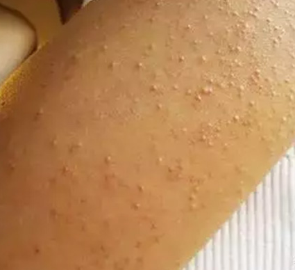 毛囊炎会传染给别人吗?青岛皮肤病研究所