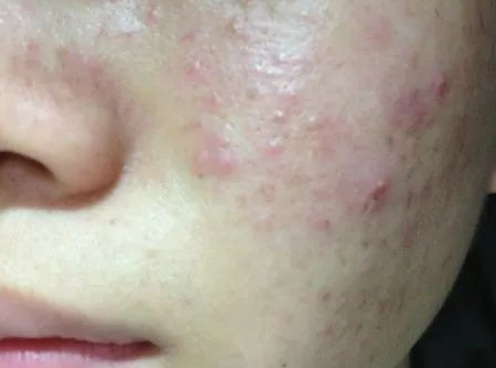 玫瑰痤疮形成原因有哪些?青岛皮肤病研究所