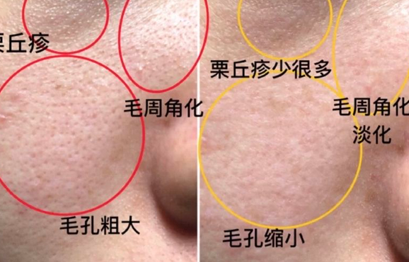 毛周角化临床表现及治疗方法,青岛皮肤病研究院