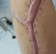 如何治疗凸起性疤痕--青岛皮肤病医院