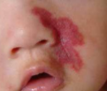 宝宝红色胎记需要治疗吗?婴幼儿的血管瘤可以自行消散吗?