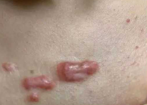 疤痕治疗需要多长时间?需要注意什么?