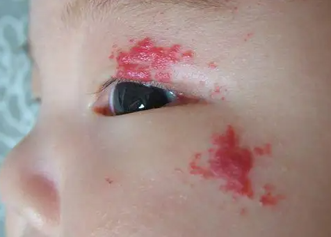 红色胎记是怎么形成的呢?青岛皮肤病医院去掉胎记方法