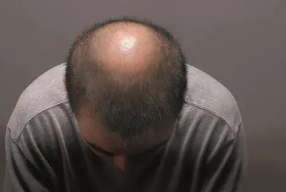 男性脱发严重应该怎么治疗?青岛皮肤病医院男性型脱发病因
