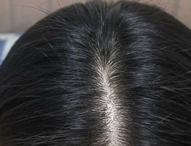 青岛皮肤病医院女性脱发原因,青岛哪里治疗脱发比较好?