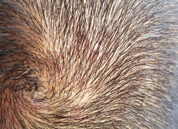 毛囊炎能不能传染给别人?青岛皮肤病医院缓解毛囊炎5种方式